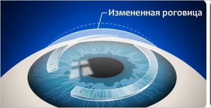 Измененная роговица.jpg Измененная роговица