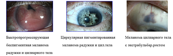 энуклеация глазного яблока энуклеация глазного яблока
