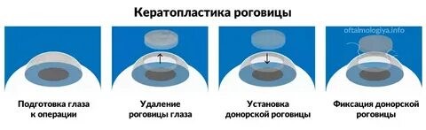 Кератопластика роговицы.jpg Кератопластика роговицы